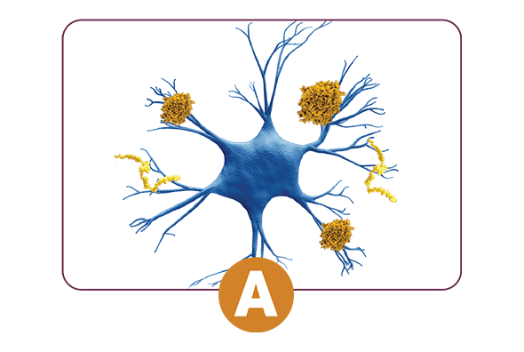 Abnormal Amyloid Beta (Aβ)